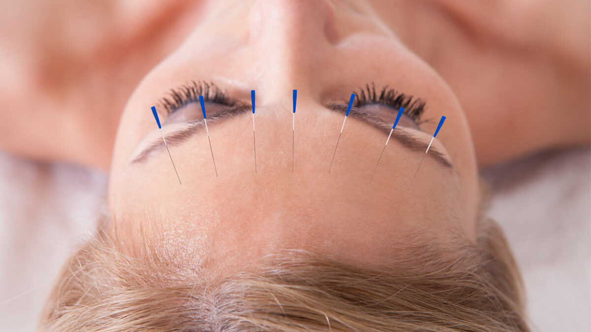 Origin, Risks, and Benefits of Acupuncture as per Mirvana Acupuncture and Chinese Herbs.