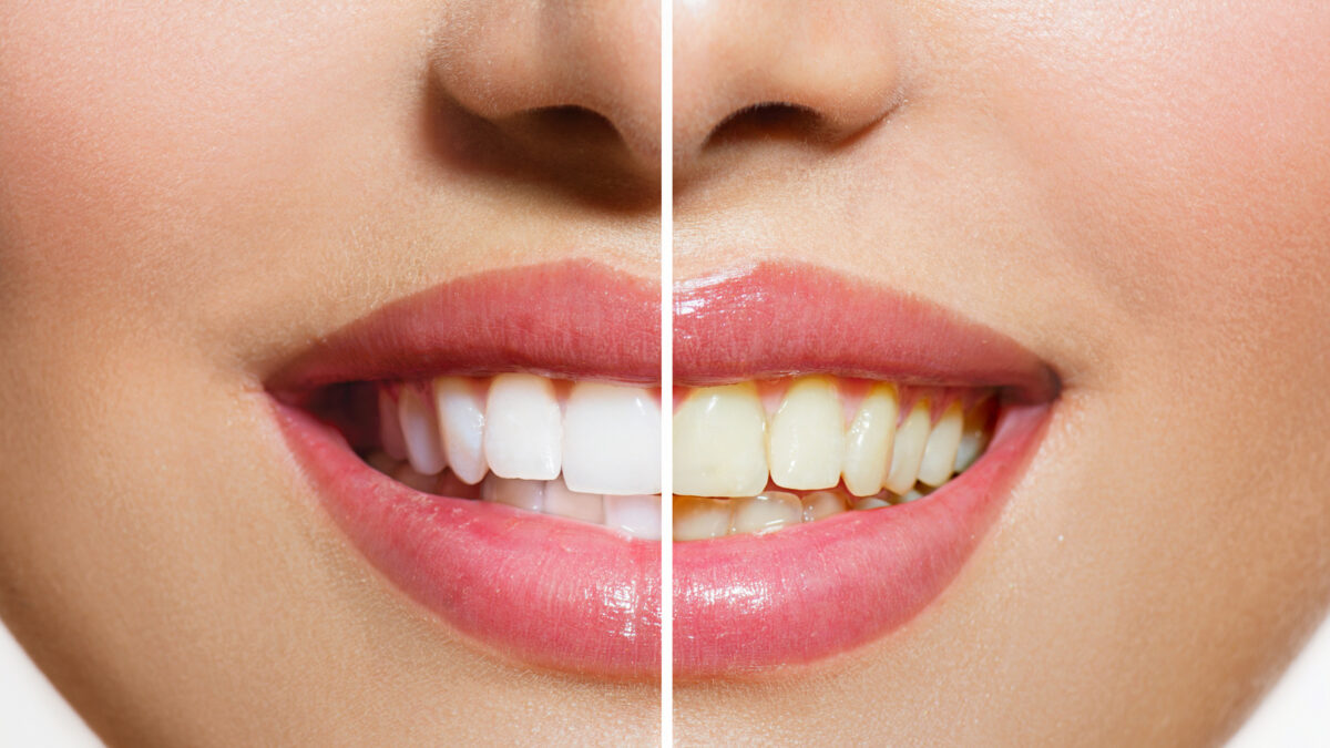 Achieving a Brighter Smile: Innovative Teeth Whitening Techniques